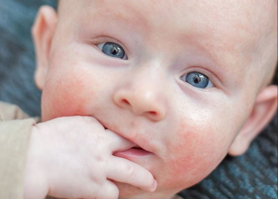 Heat rash in the baby - what it is and how to relieve it - Roditel.bg ...