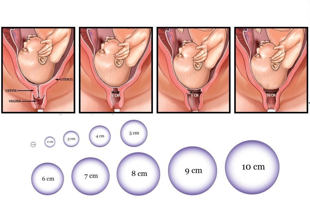 разкритие разширение маточна шийка раждане